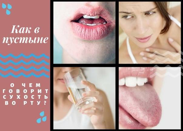 Сухость во рту (ксеростомия) - недостаточное слюноотделение | лечение и устранение причин сухости полости рта
